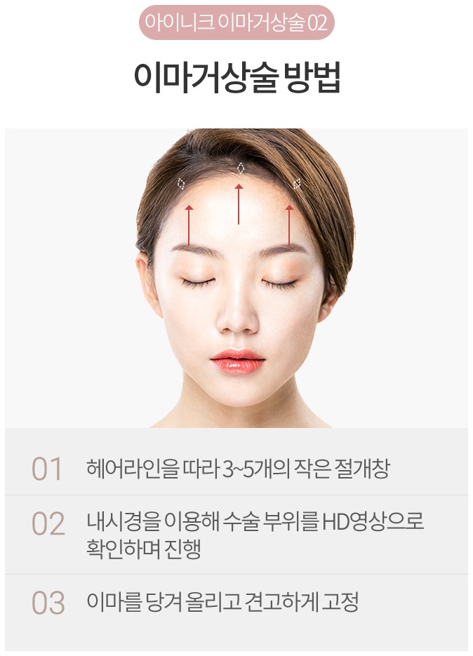 이마거상술비용 신중하게 알아보자 관련 이미지 4