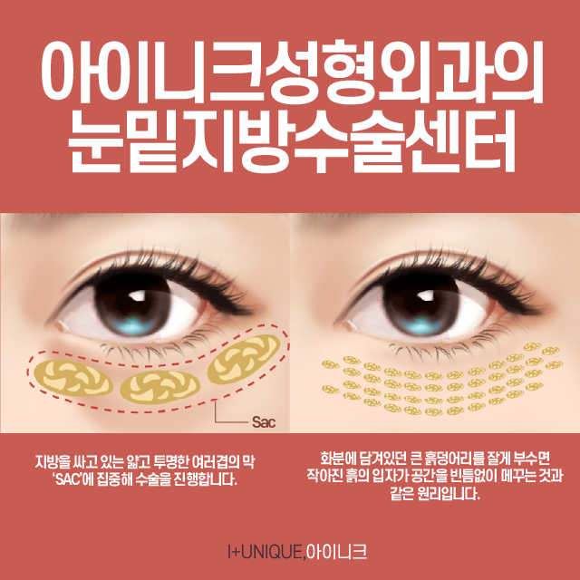 눈밑수술센터 추천, 새로운 개념의 바로 이것 관련 이미지 2