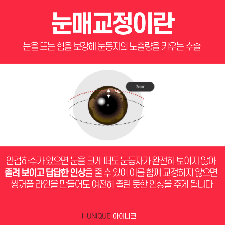 서울눈성형외과를 알아본다면, 신중한 결정이 필요하다 관련 이미지 3