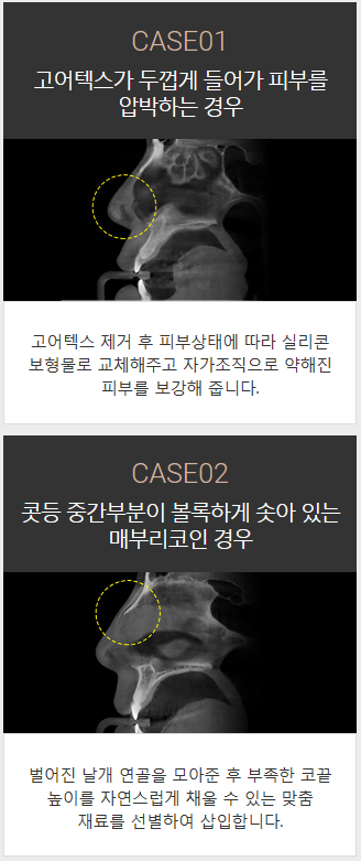 코보형물종류 나에게 맞는 걸로 선택하자 관련 이미지 2