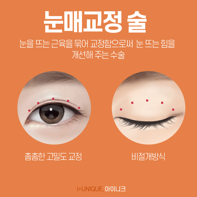 눈꺼풀수술, 종류도 다양하다! 아이니크에서 내 눈에 맞는 성형 알아보기 관련 이미지 3