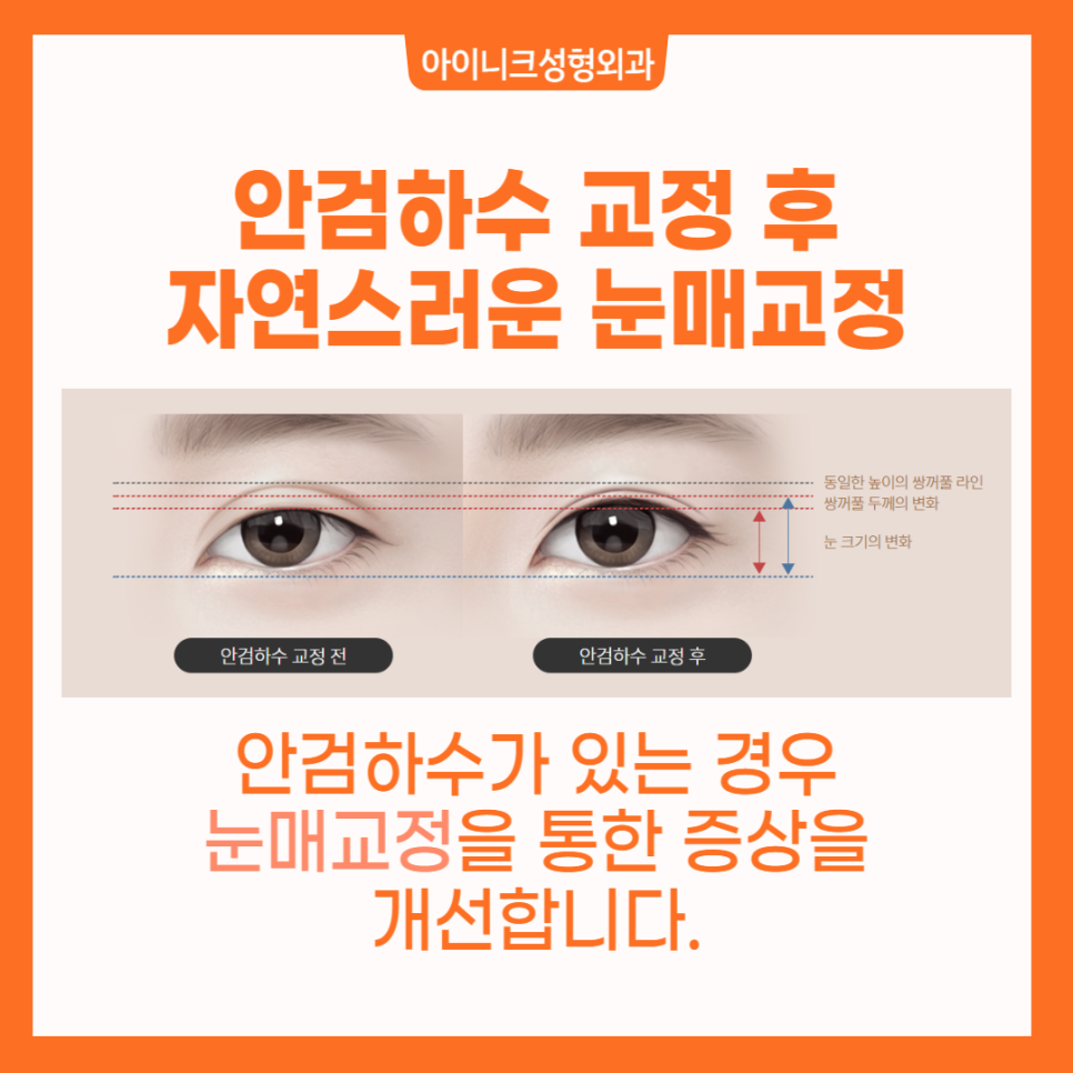 소시지눈해결방법으로 알아보는 확실한 재수술 관련 이미지 4