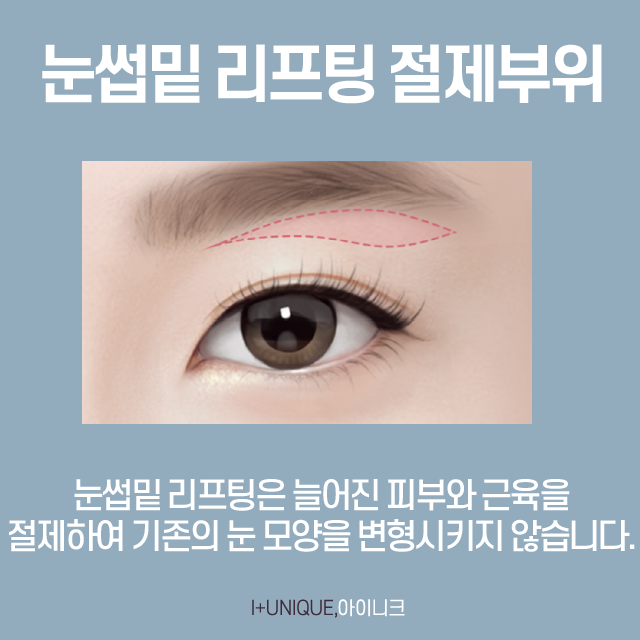 The Most Important Key Point for Successful Middle-Age Eye Surgery image 4