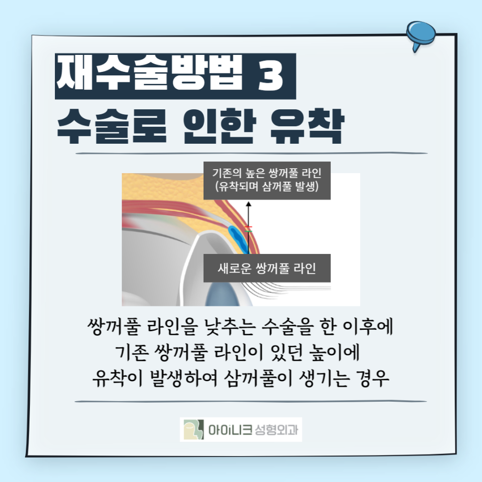 겹쌍꺼풀수술이고민이라면? 관련 이미지 6
