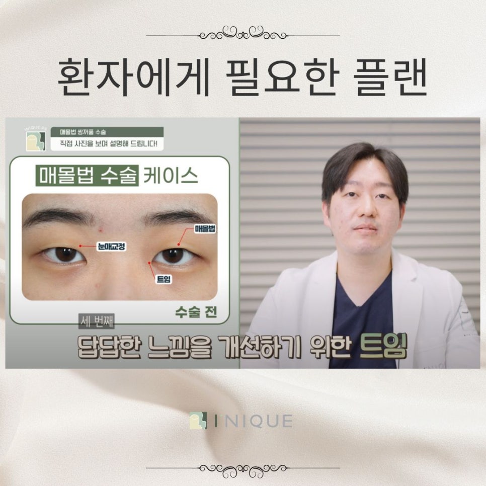 여자눈매몰법 고려해야하는 점 관련 이미지 4