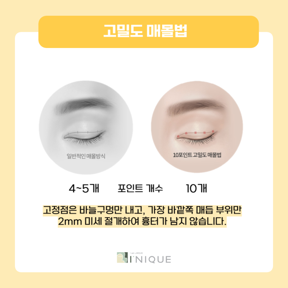 The Best Place for Double Eyelid Surgery for Women Is Right Here! image 3
