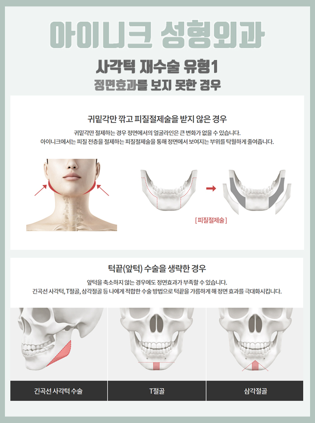 사각턱재건 두 번의 실패 없이 정확한 원인 해결! 관련 이미지 4