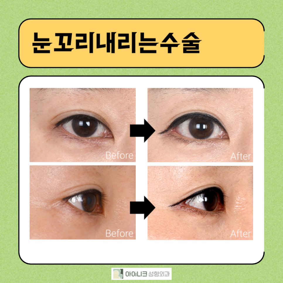 눈꼬리내리는수술로 강아지상 만들기 관련 이미지 2