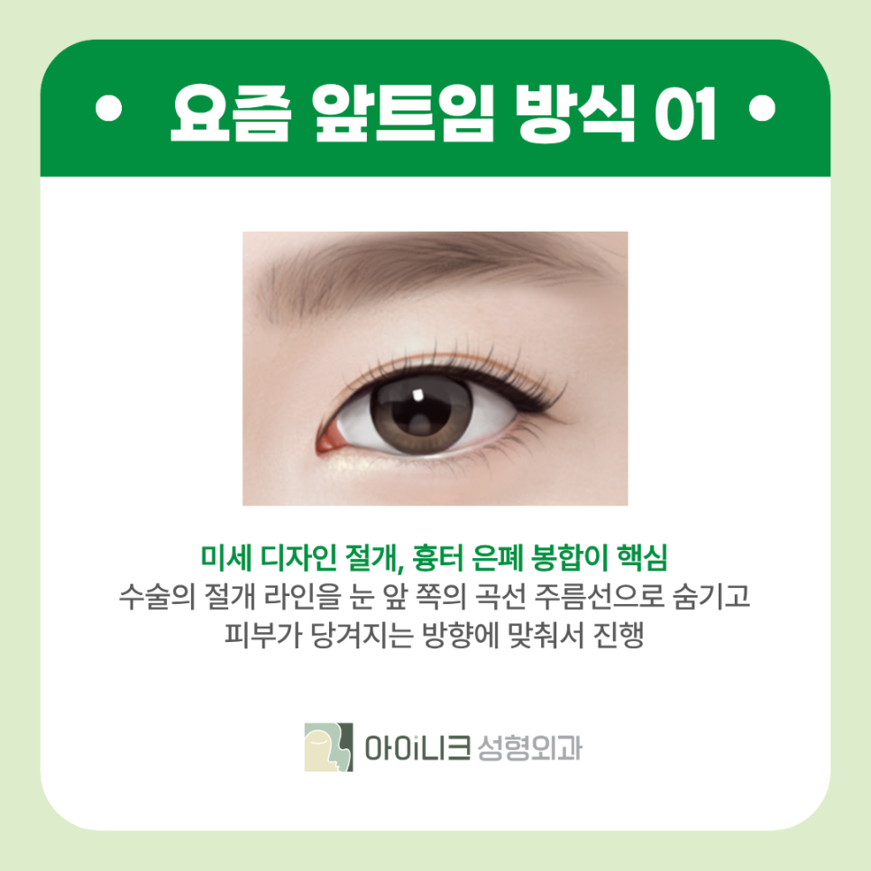 The 20s’ Pick These Days! An Epicanthoplasty Method Without Worrying About Scars image 4