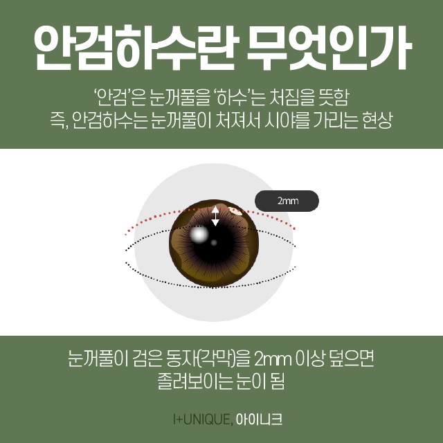 졸린눈이 고민이라면 눈매교정안검하수로 또렷하게 되돌리자 관련 이미지 2