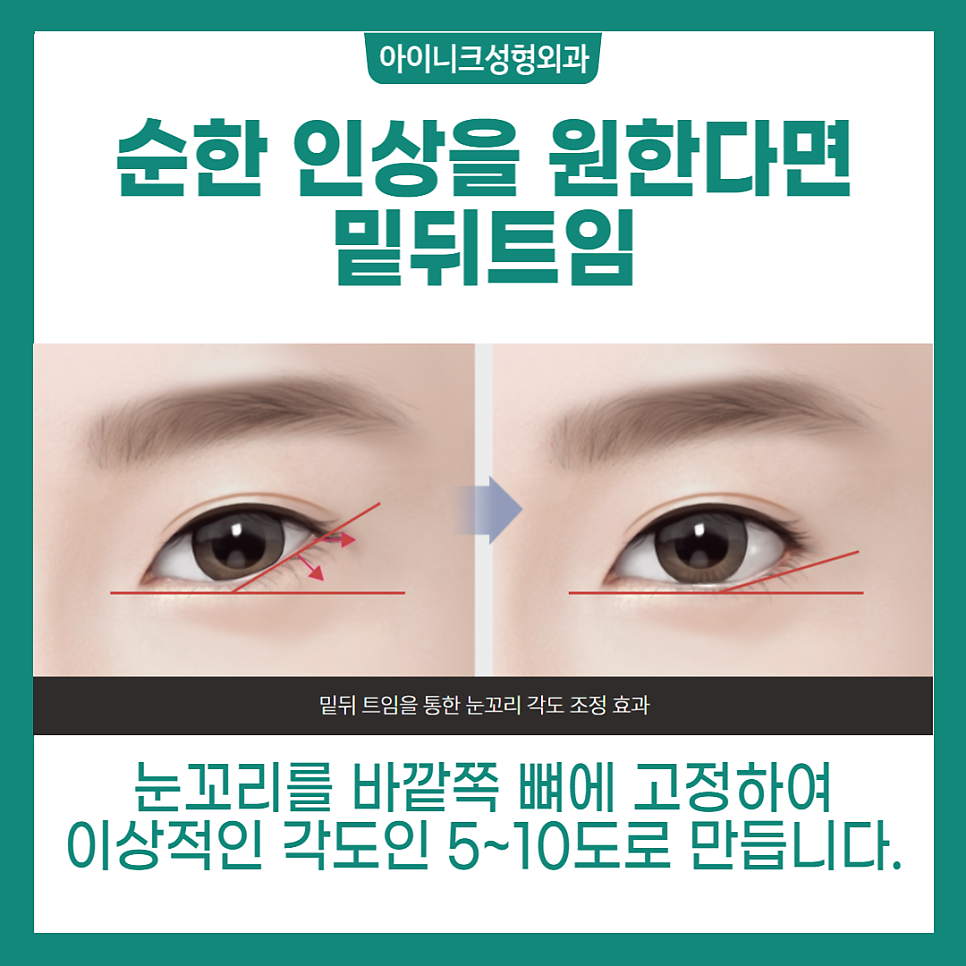 뒤트임잘하는곳 찾고 있나요? 관련 이미지 5