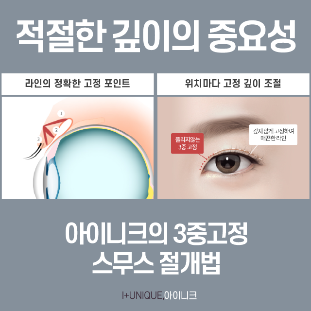 자연스러운 쌍수를 위해 꼭 알아야 하는 이것 관련 이미지 4
