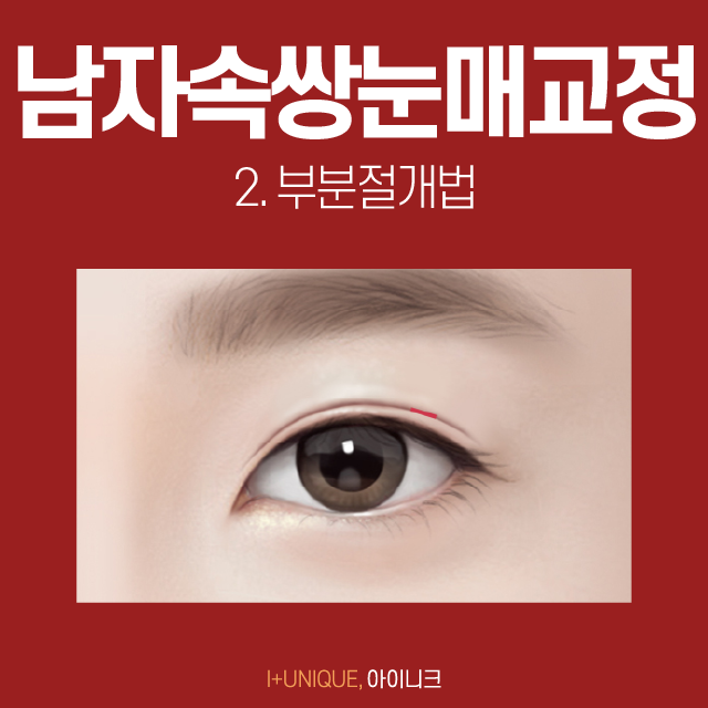 If You Want Natural, Clear Double Eyelids? Male Double-Eyelid Eye Correction Is the Answer! image 3