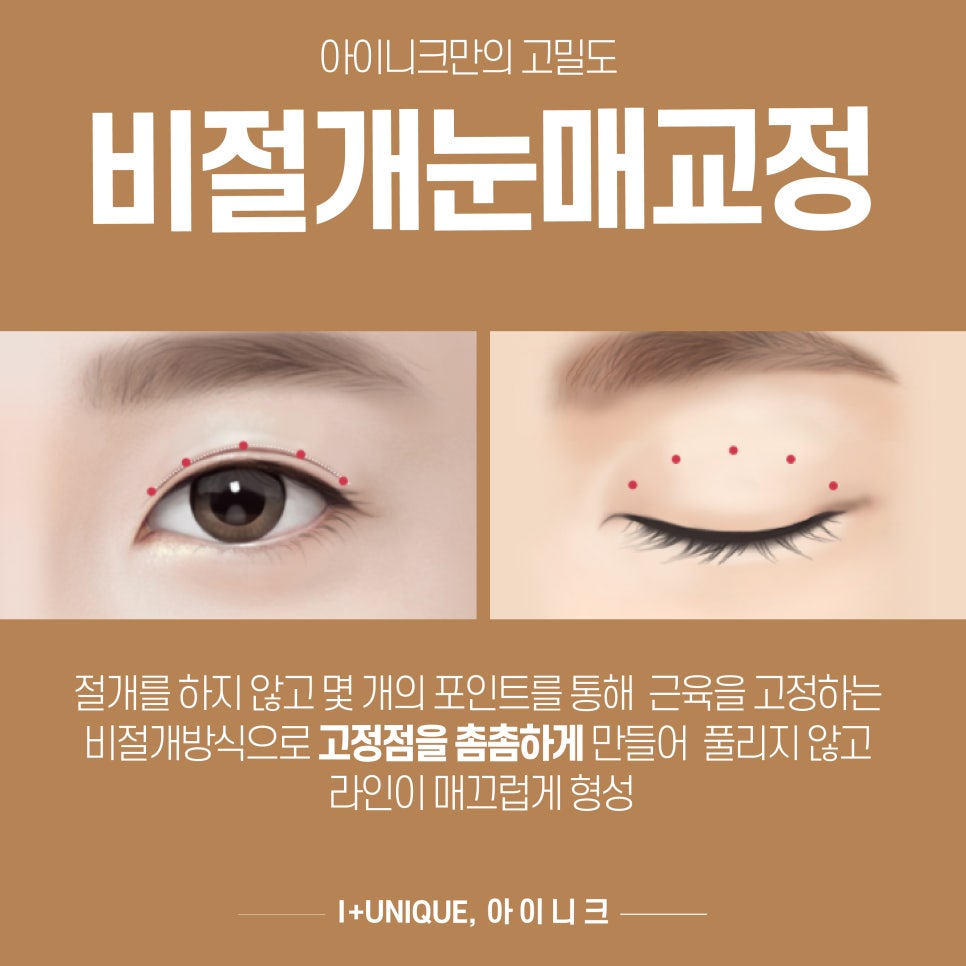 비절개안검하수 수술을 찾고 있다면 아이니크성형외과로 관련 이미지 4