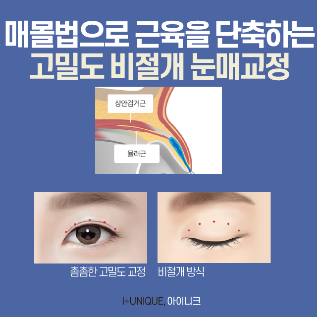 눈매교정술에 대해 무엇이든 물어보세요! 관련 이미지 3