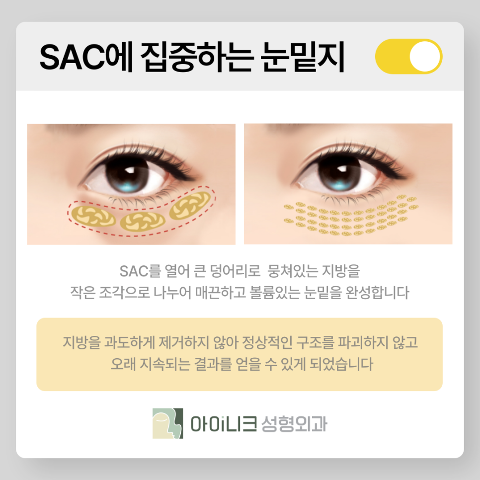눈밑지병원 멍과 붓기가 걱정되나요? 관련 이미지 13
