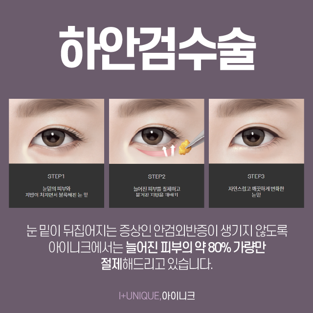 압구정 상안검수술 눈꺼풀이 늘어진 분이라면 주목 관련 이미지 5
