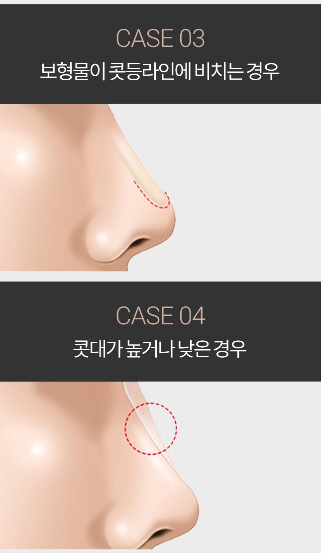 코재건수술 두 번의 실수는 없다! 관련 이미지 4