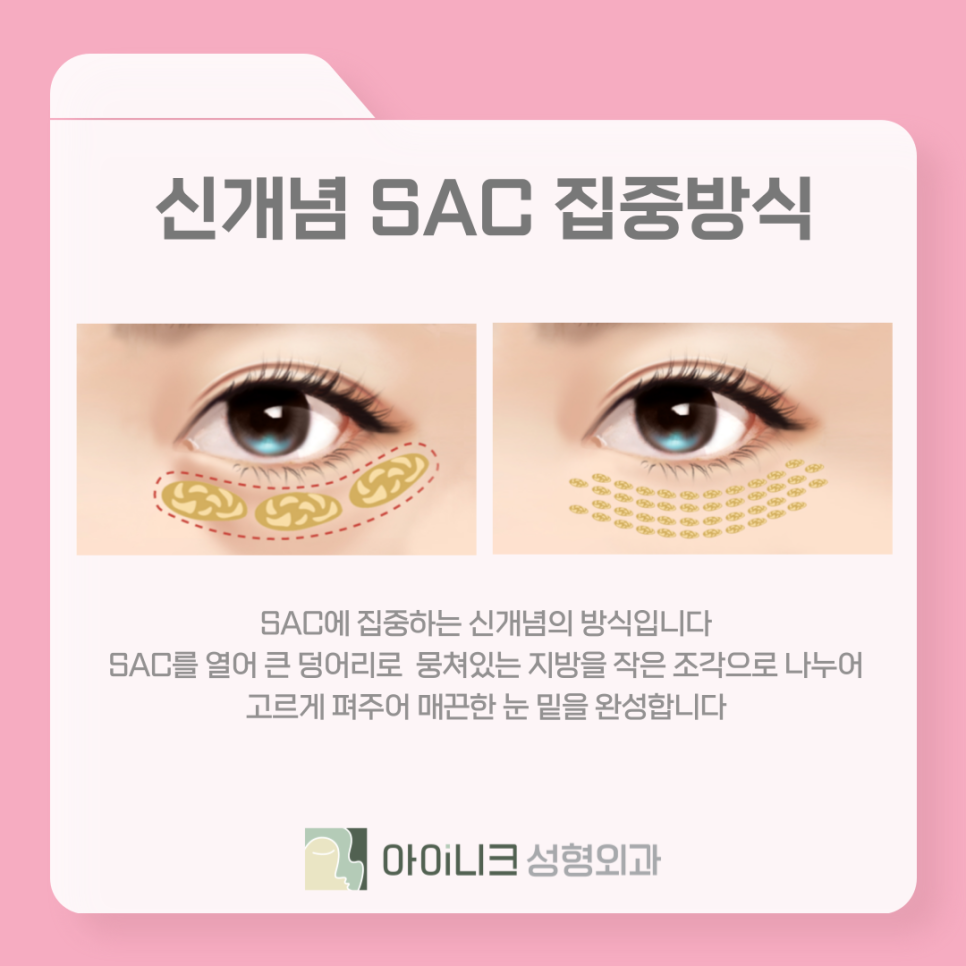 눈밑지방재배치재수술 통증적고 회복 빠른 방법은? 관련 이미지 9