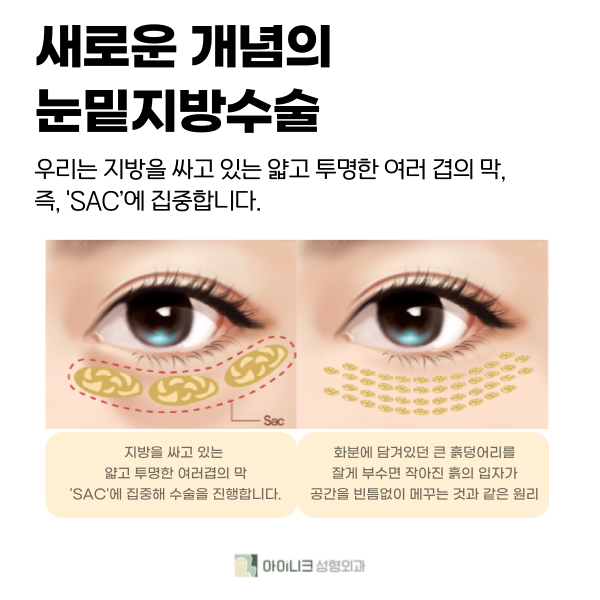 눈밑지방재배치잘하는곳에서 알려주는 꿀팁 관련 이미지 3