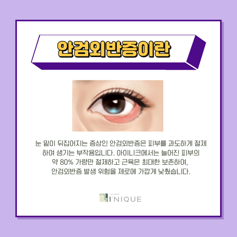 동안눈성형으로 자신감 회복 관련 이미지 5