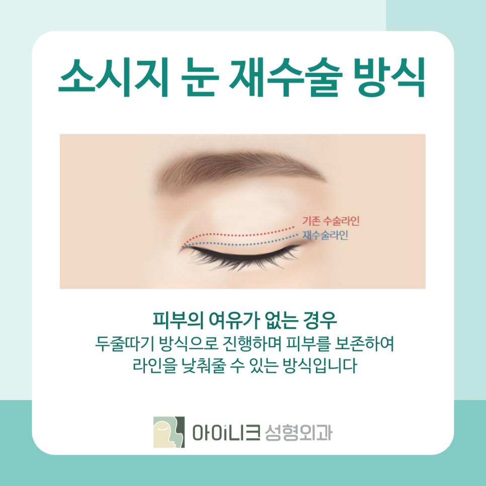 청담역 눈재수술 병원 고민되시나요? 관련 이미지 6