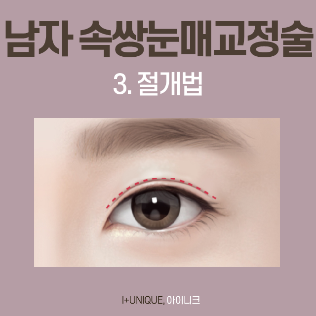 쌍꺼풀 없이도 또렷한 눈매를 원한다면 무쌍눈매교정술! 관련 이미지 4