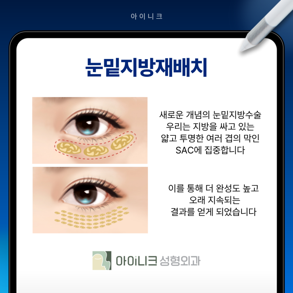 눈밑처짐 해결로 자연스러운 동안 만들기 관련 이미지 7