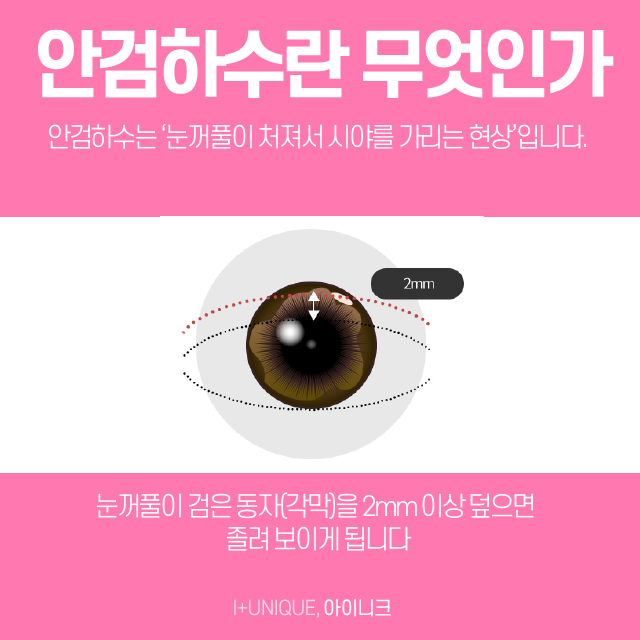 안검하수병원, 아무데나 갈수는 없죠 관련 이미지 2