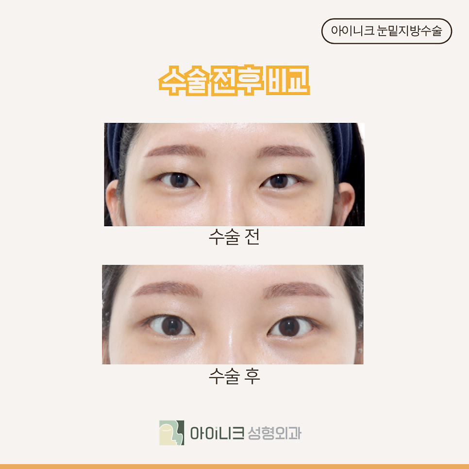 How Long Is the Recovery Period After Under-Eye Fat Repositioning Surgery at Sinsa Station? image 5