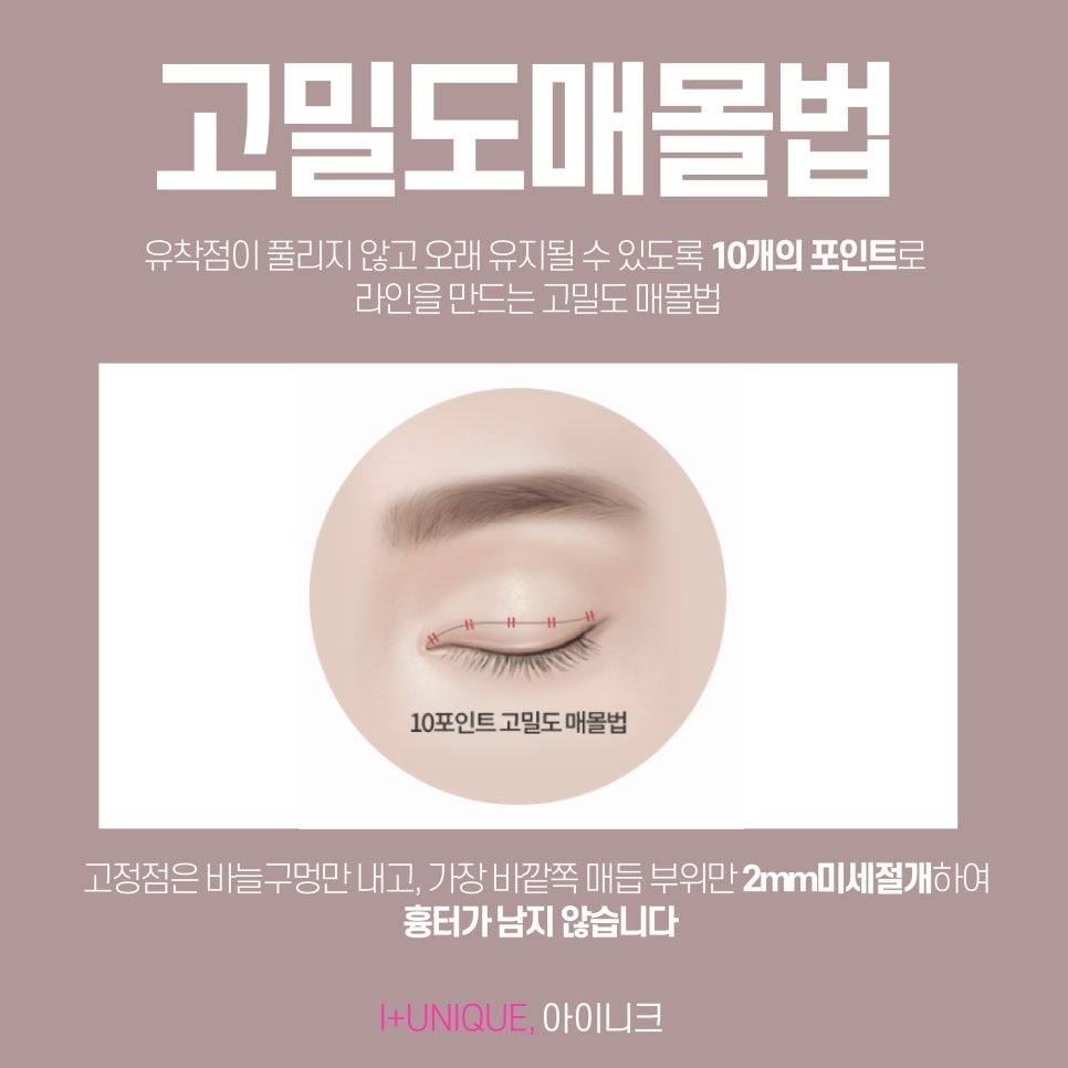 자연스러운 눈꺼풀성형 찾고 있다면 아이니크성형외과로 관련 이미지 4