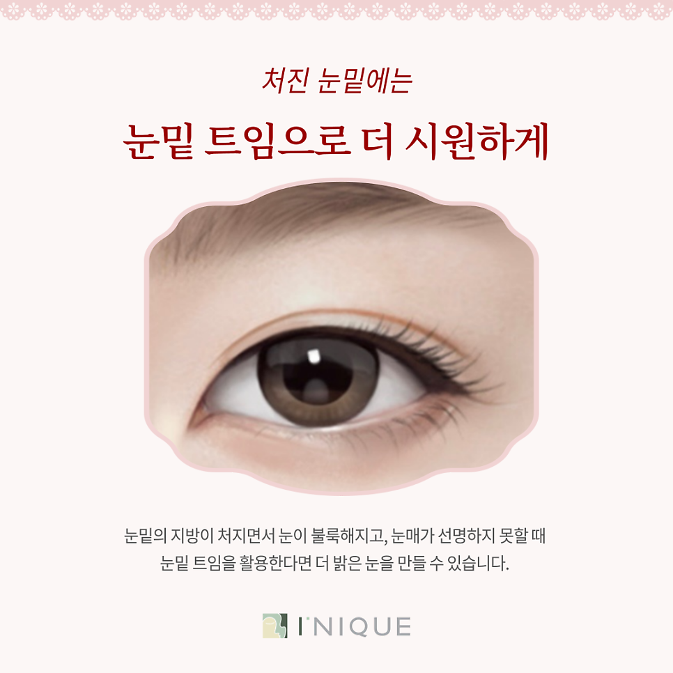 눈밑트임잘하는곳, 어떻게 선택할까요? 관련 이미지 3