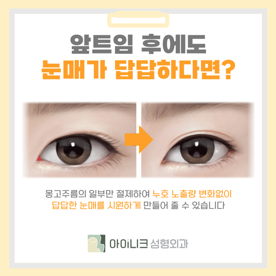 압구정 앞트임 재수술 꼼꼼함이 중요해요 관련 이미지 7
