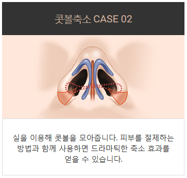 콧구멍축소수술가격 작지만 큰 효과 관련 이미지 4