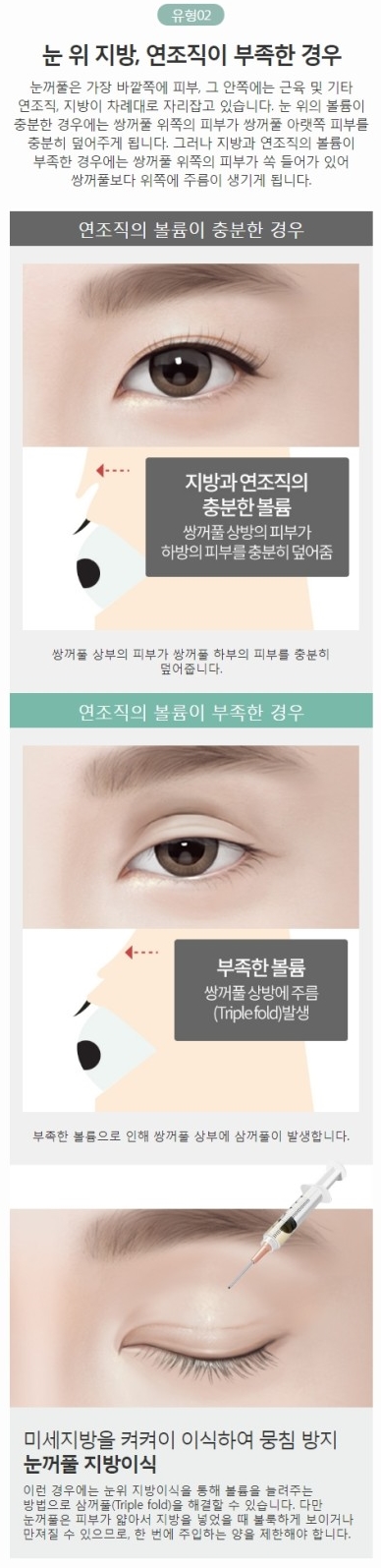 겹쌍꺼풀수술 원인별 맞춤 솔루션으로 완벽 해결! 관련 이미지 4