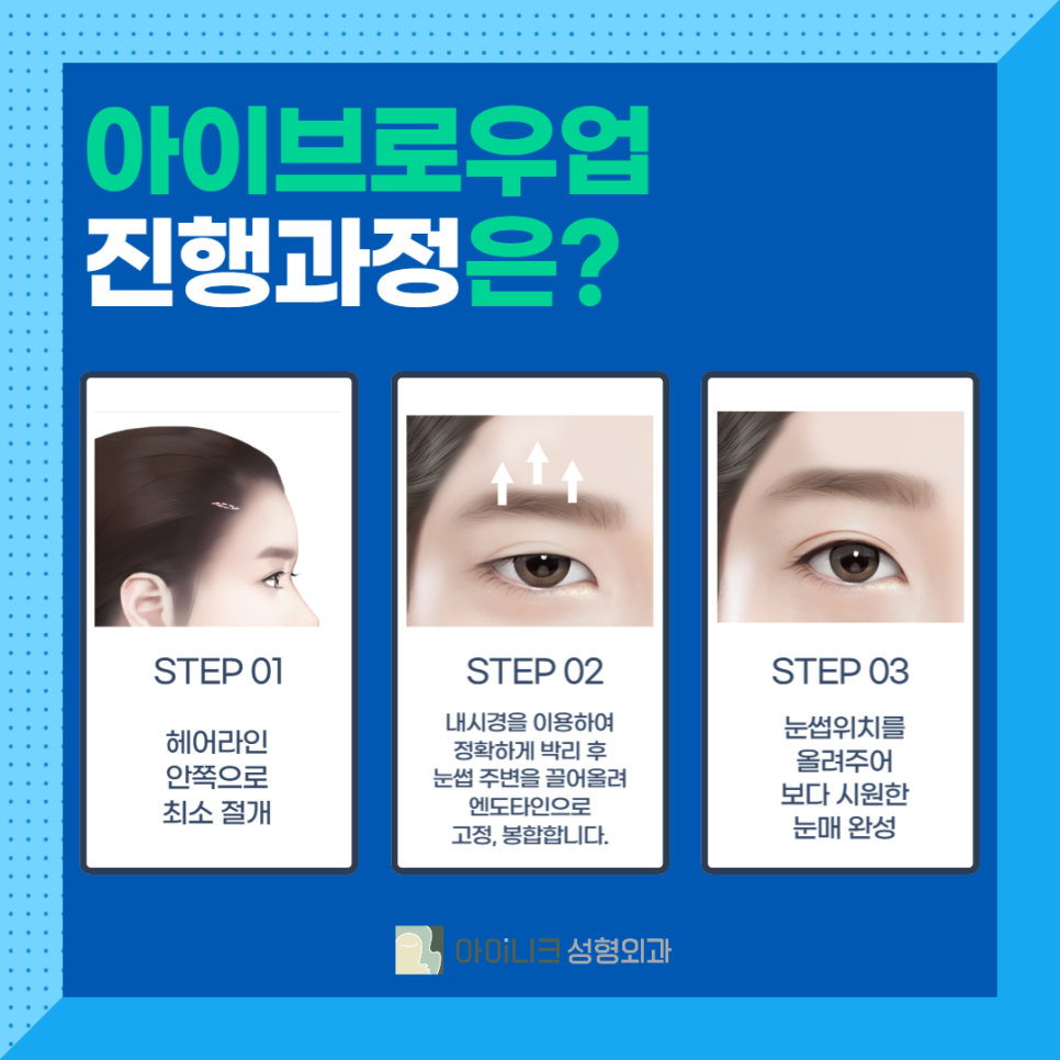 Brow Lift Surgery Improved to Create a Clearer Impression image 3