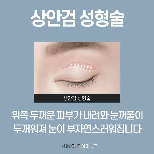 Restoring Firmness Again with Successful Middle-Age Eye Surgery! image 3