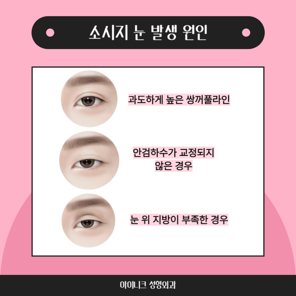 쌍꺼풀재수술병원, 실패없는 재수술을 위해 관련 이미지 2