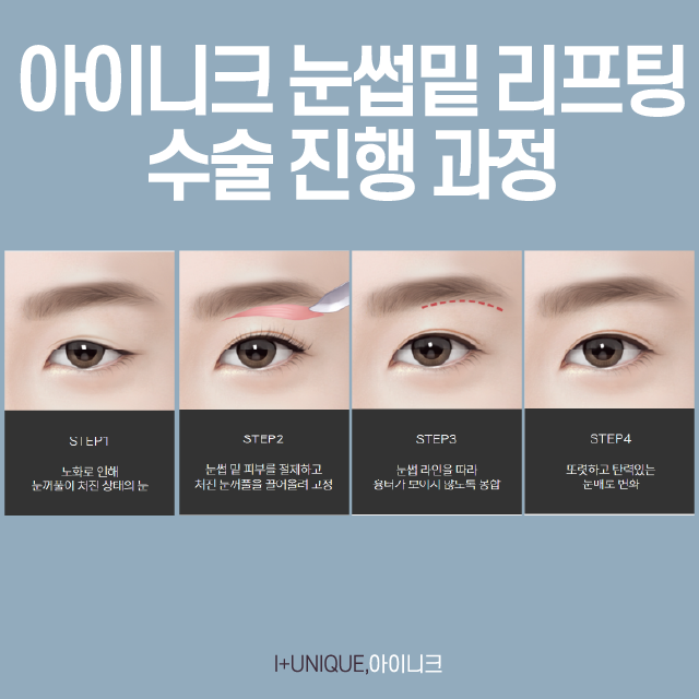 The Most Important Key Point for Successful Middle-Age Eye Surgery image 3