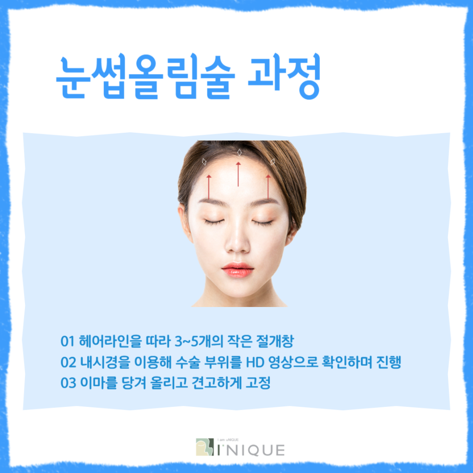 Are you looking for eyebrow surgery for people in their 30s? image 4