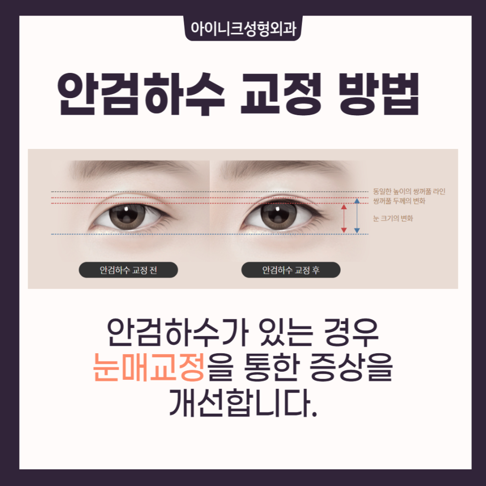 소세지쌍꺼풀재수술, 고민한다면 관련 이미지 5