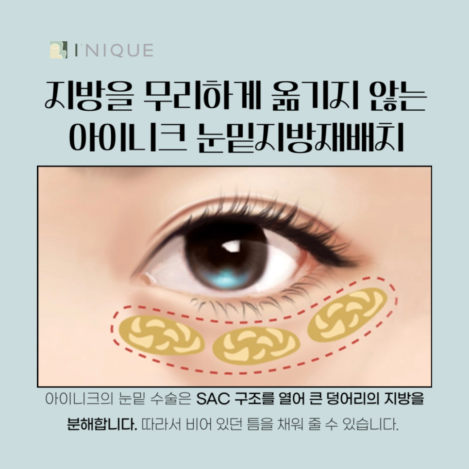 눈밑지방재배치수술후 변화를 기대한다면 관련 이미지 3