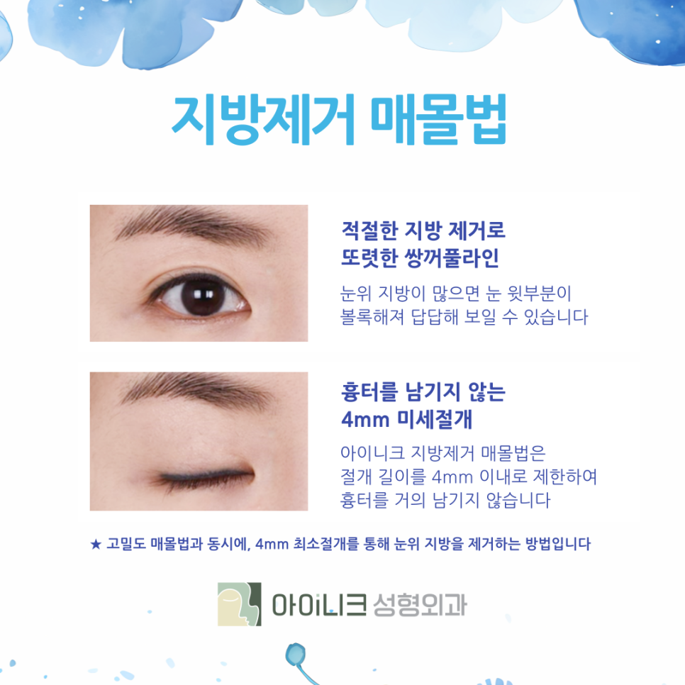 압구정쌍꺼풀 자연스럽게 예뻐지려면 관련 이미지 6