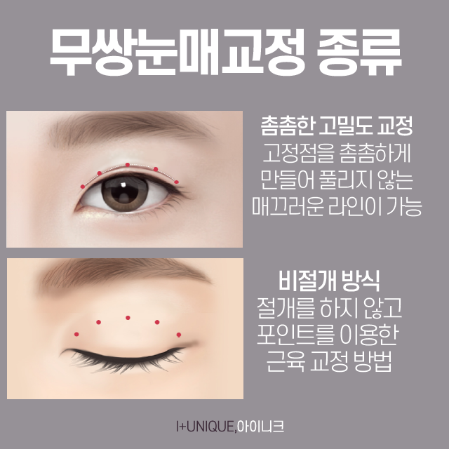 남자눈성형성공 하는 방법? 자연스럽고 부드럽게 관련 이미지 5