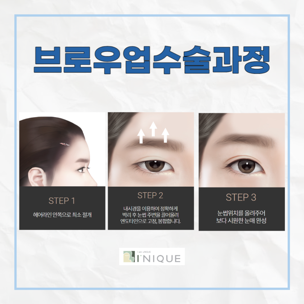 눈꺼풀처짐수술비용, 합리적인 선택을 하려면? 관련 이미지 4