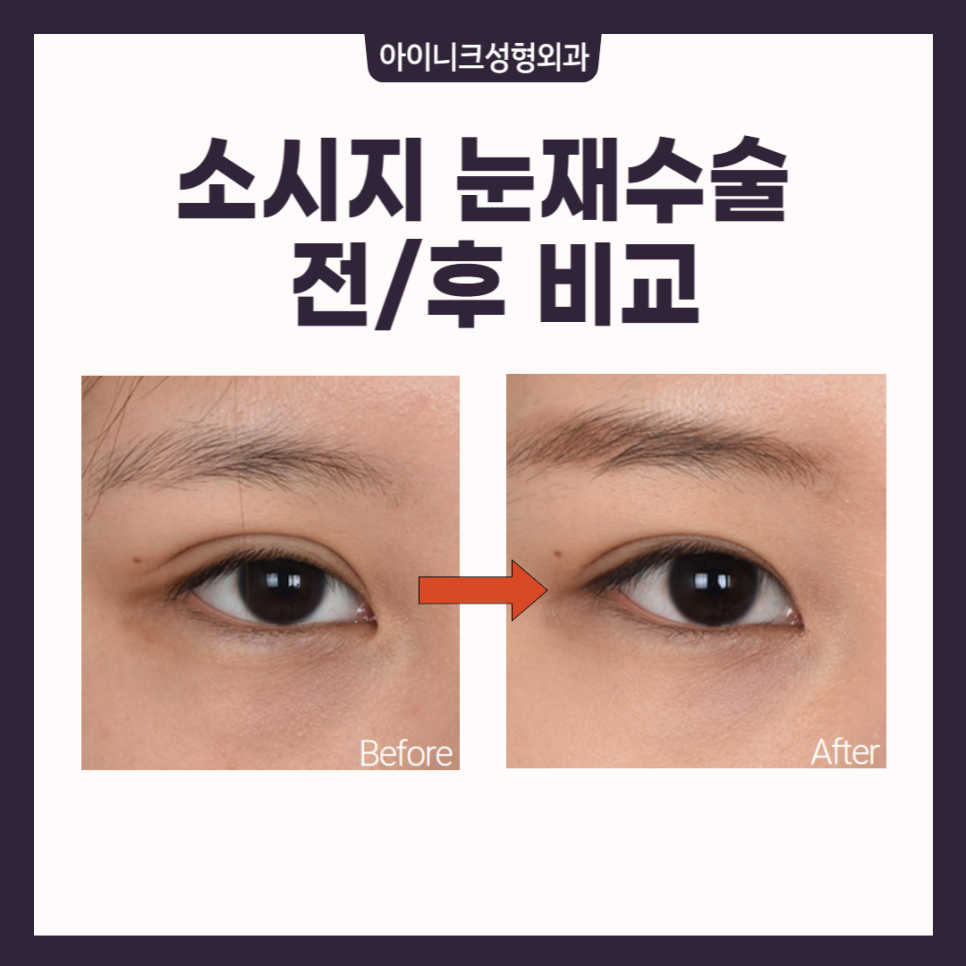 소세지쌍꺼풀재수술, 고민한다면 관련 이미지 4