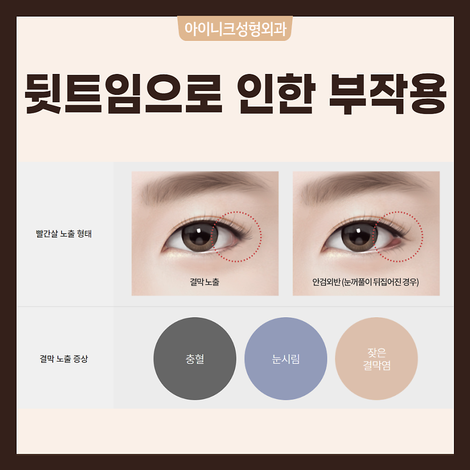 다양한 트임수술 같이 알아봐요! 관련 이미지 4