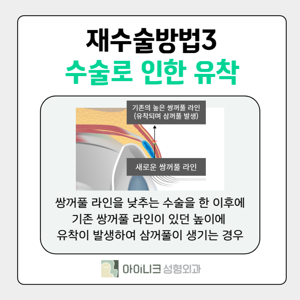 If You’re Curious About How to Fix Multiple Eyelid Folds image 5