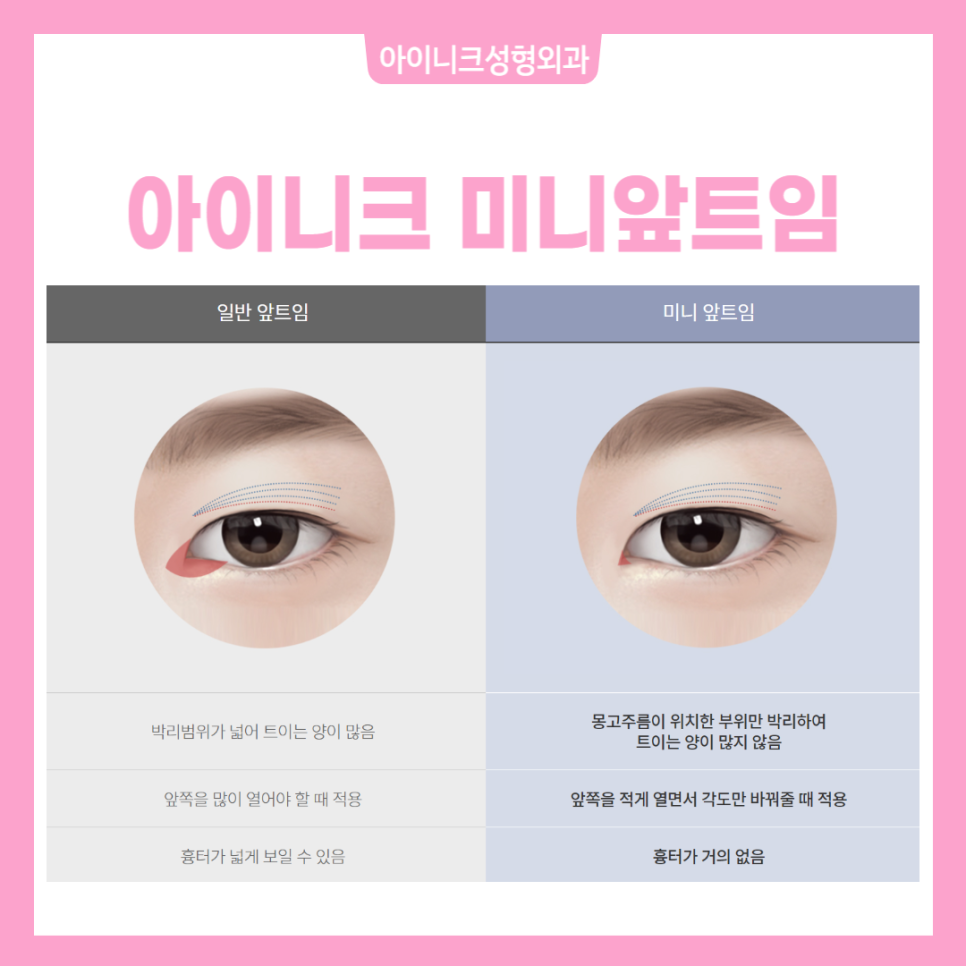 앞트임뒤트임 아름다운 눈을 위한 선택 관련 이미지 3