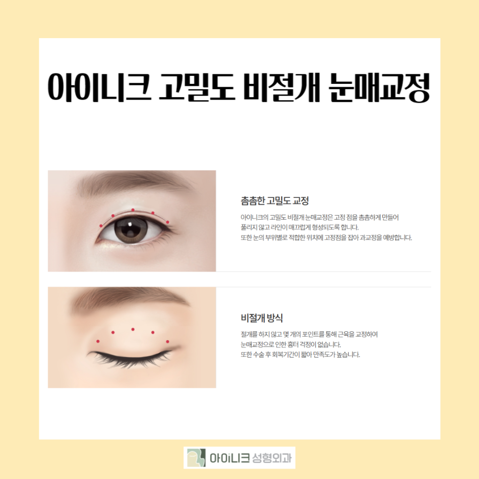 What Are the Reasons Double Eyelid Surgery Fails, and What Is the Right Revision Method? image 6